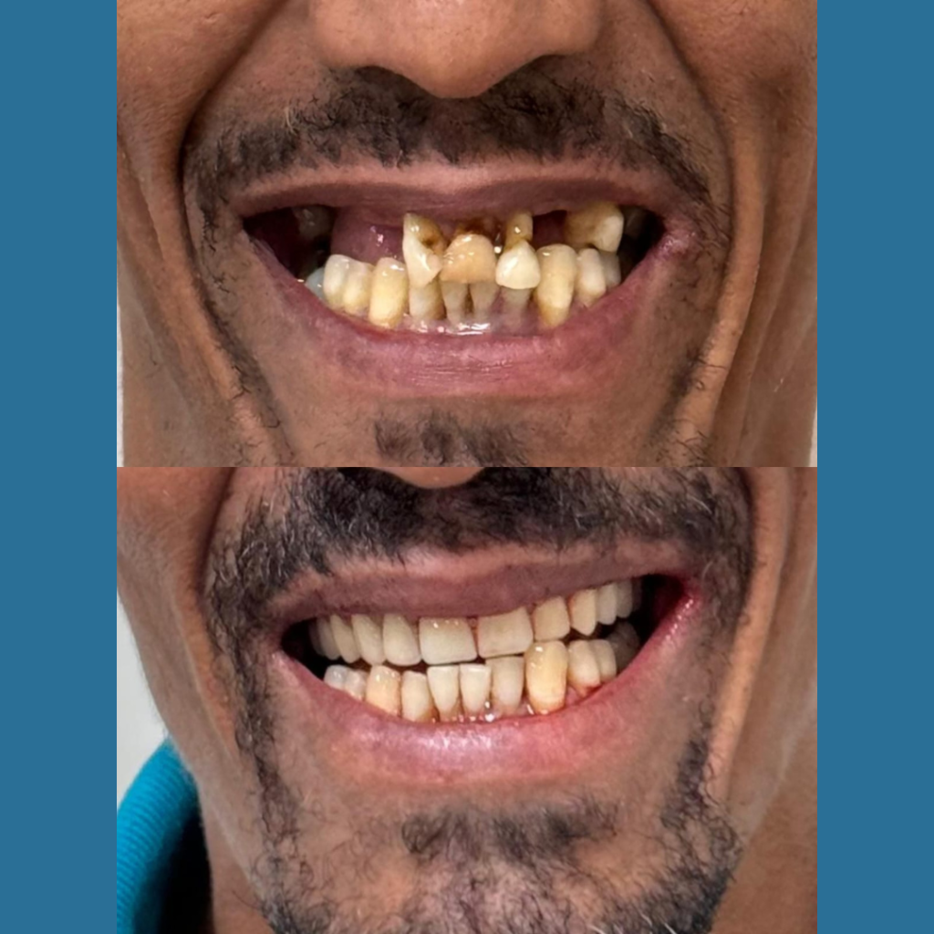 antes e depois - implantodontia